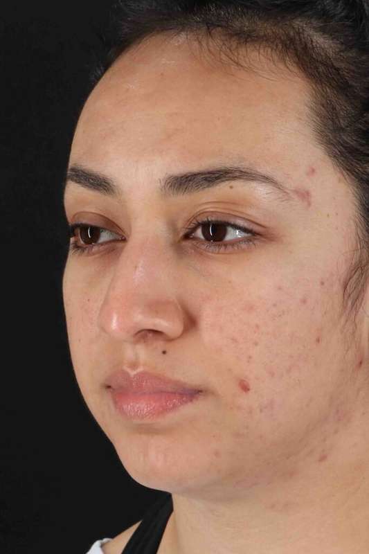 Rhinoplasty Before & After Patient #5881