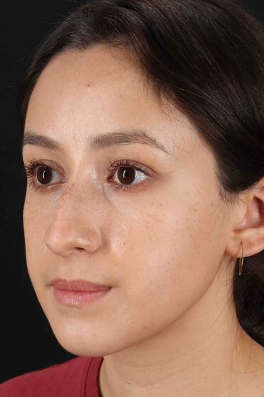 Rhinoplasty Before & After Patient #5892