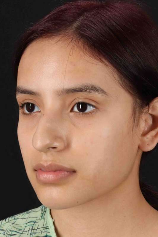 Rhinoplasty Before & After Patient #5903
