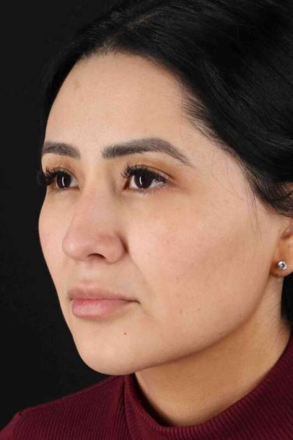 Rhinoplasty Before & After Patient #5925