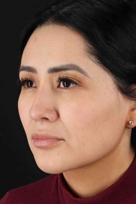 Rhinoplasty Before & After Patient #5925
