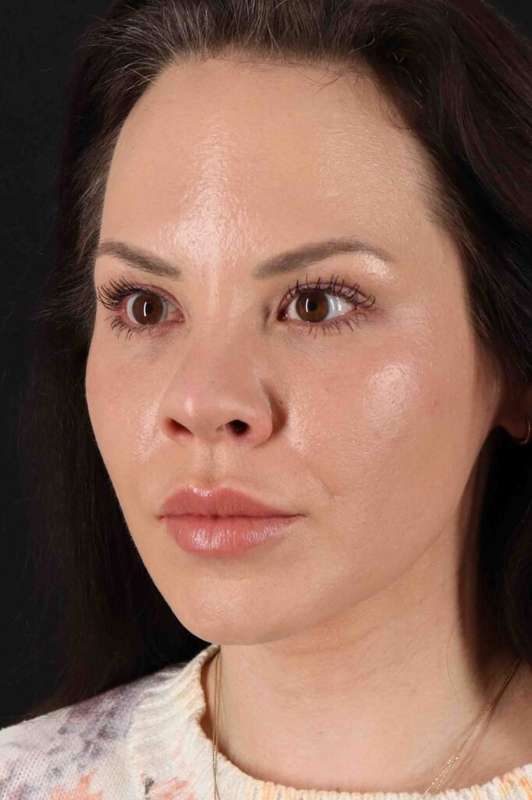 Rhinoplasty Before & After Patient #5936