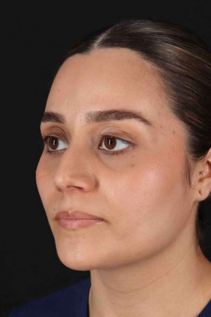 Rhinoplasty Before & After Patient #5947