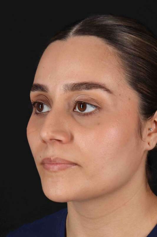 Rhinoplasty Before & After Patient #5947