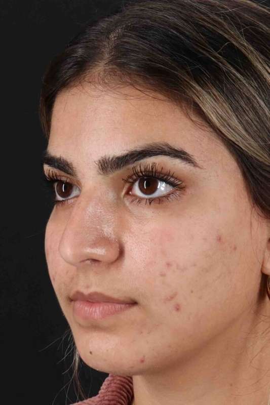 Rhinoplasty Before & After Patient #5958