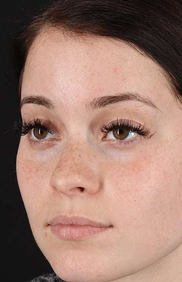 Rhinoplasty Before & After Patient #6178