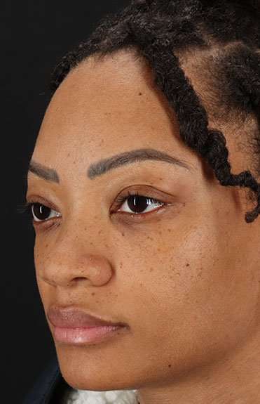 Rhinoplasty Before & After Patient #6189