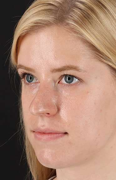 Rhinoplasty Before & After Patient #6200