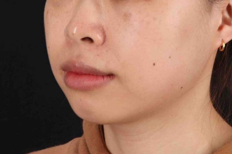 Lip Reduction Before & After Patient #6222