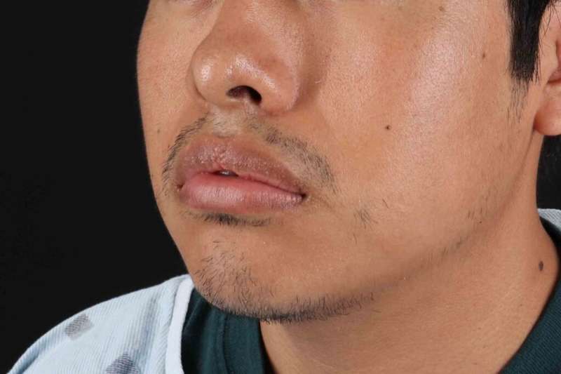 Lip Reduction Before & After Patient #6233