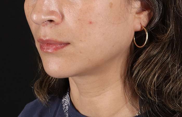 Lip Lift Before & After Patient #6244