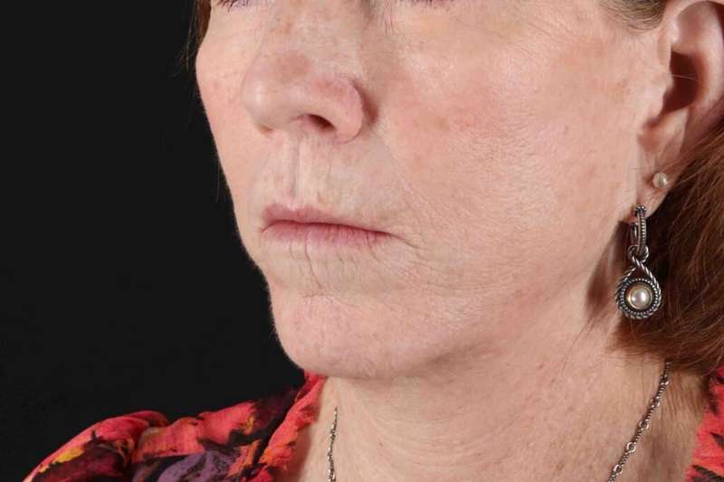 Lip Lift Before & After Patient #6255