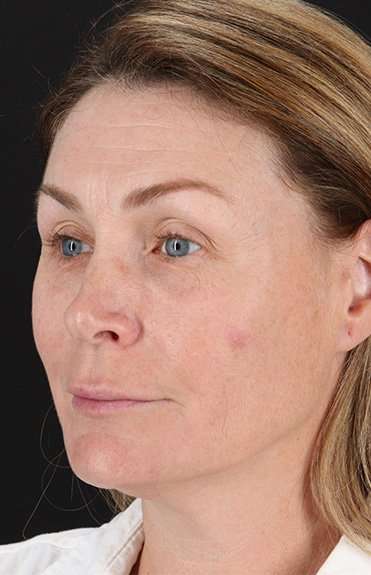 Lip Lift Before & After Patient #6266