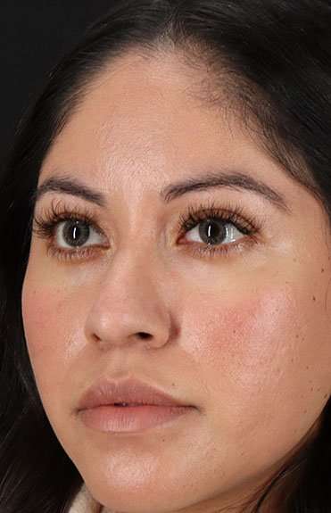 Liquid Rhinoplasty Before & After Patient #6319