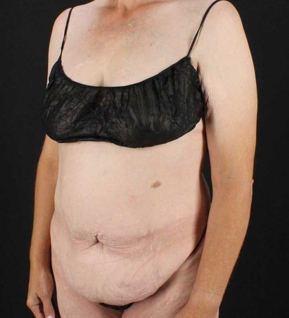 Cosmetic Body Lift Before & After Patient #1218