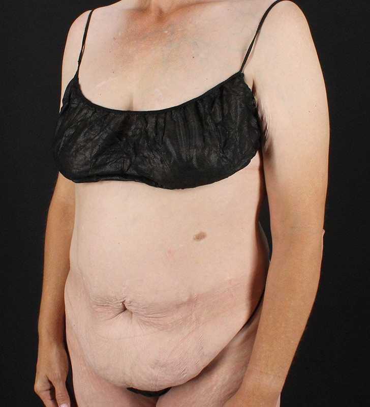 Cosmetic Body Lift Before & After Patient #1218