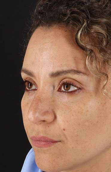Liquid Rhinoplasty Before & After Patient #6333