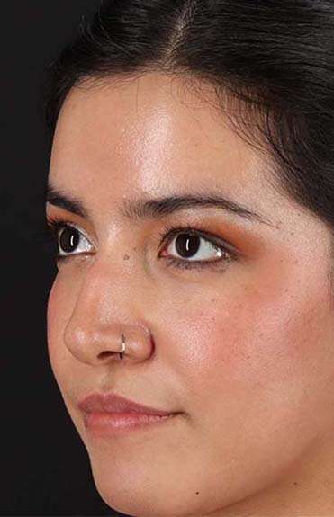 Liquid Rhinoplasty Before & After Patient #6344