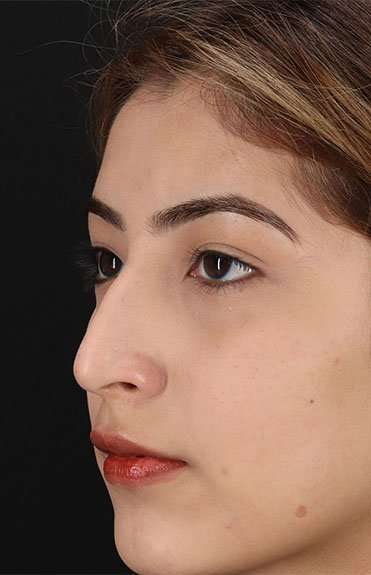 Liquid Rhinoplasty Before & After Patient #6355