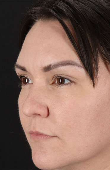 Liquid Rhinoplasty Before & After Patient #6366
