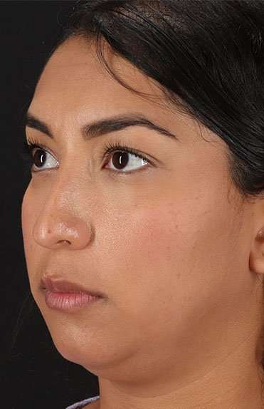 Liquid Rhinoplasty Before & After Patient #6377