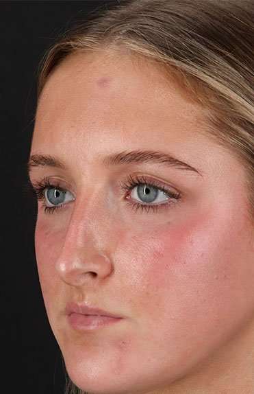 Liquid Rhinoplasty Before & After Patient #6388