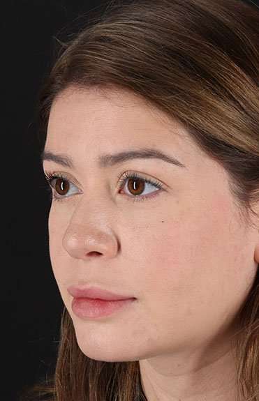 Liquid Rhinoplasty Before & After Patient #6399