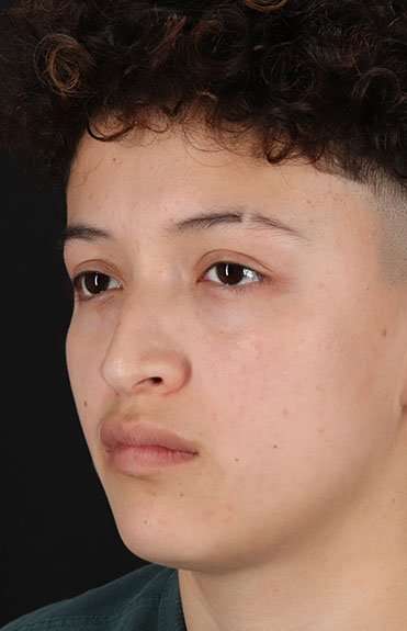 Liquid Rhinoplasty Before & After Patient #6410