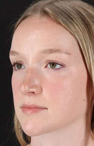 Liquid Rhinoplasty Before & After Patient #6425