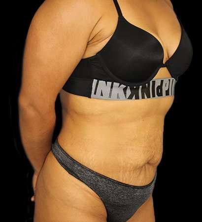 Abdominoplasty (Tummy Tuck) Before & After Patient #601