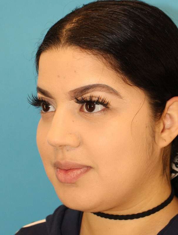 Buccal Fat Pad Before & After Patient #6436