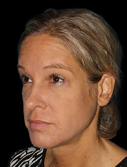 Neck Lift Before & After Patient #6517