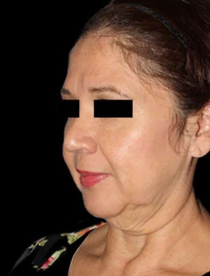 Neck Lift Before & After Patient #6539