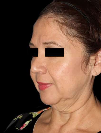 Neck Lift Before & After Patient #6539