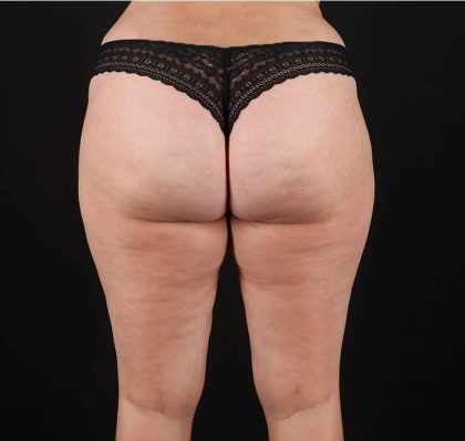 Liposuction Before & After Patient #1249