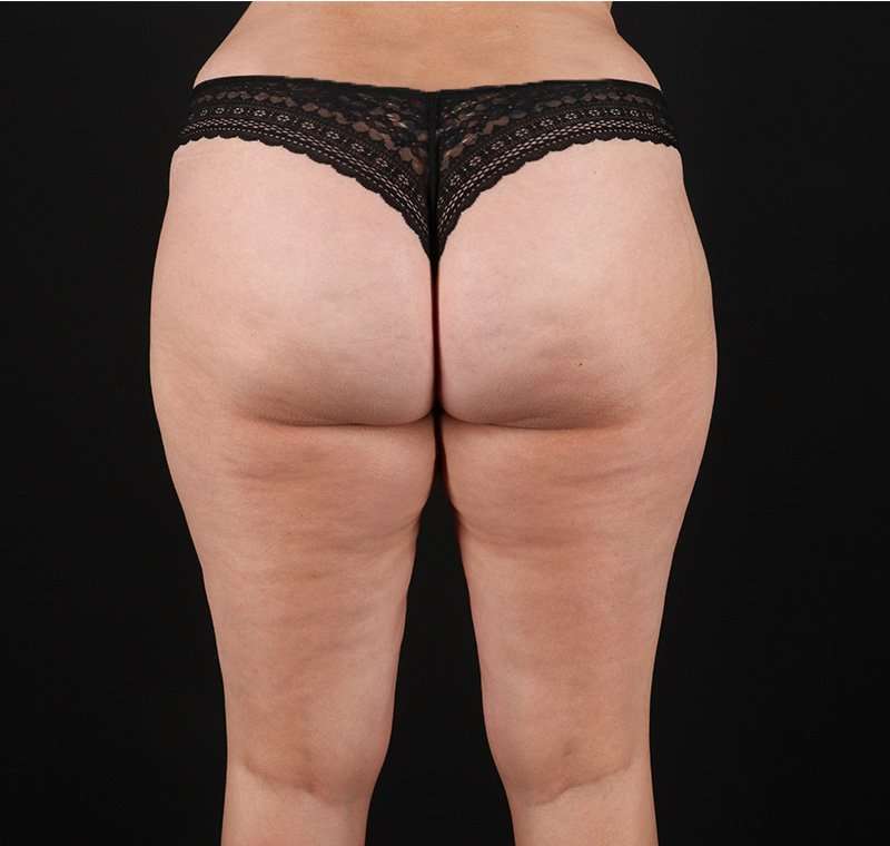 Liposuction Before & After Patient #1249