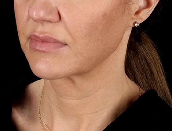 Neck Lift Before & After Patient #6676