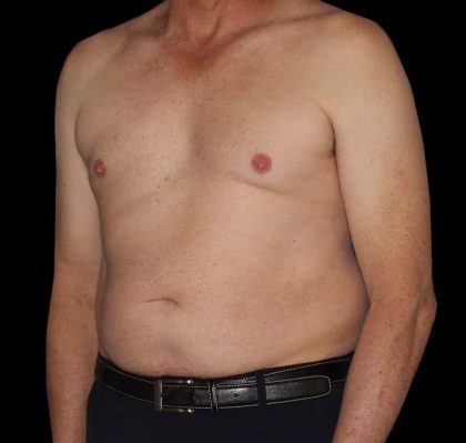 Liposuction Before & After Patient #1270