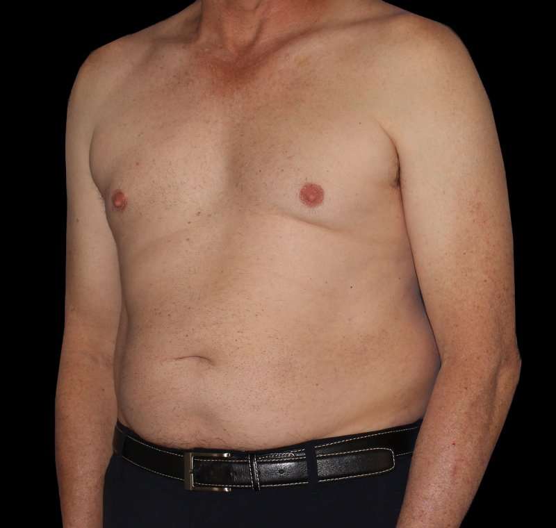 Liposuction Before & After Patient #1270