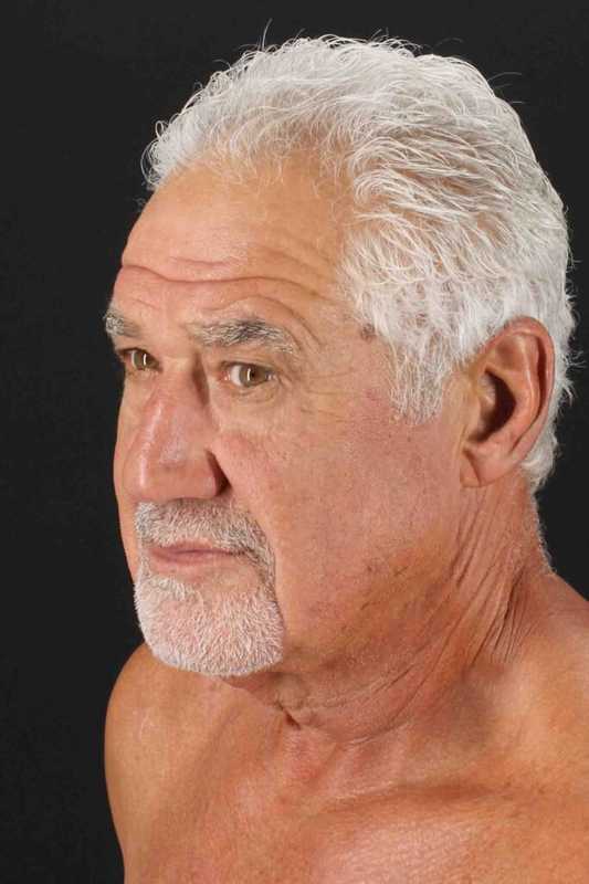 Neck Lift Before & After Patient #6788