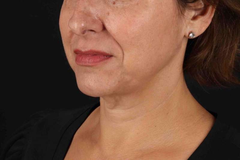 Neck Lift Before & After Patient #6797