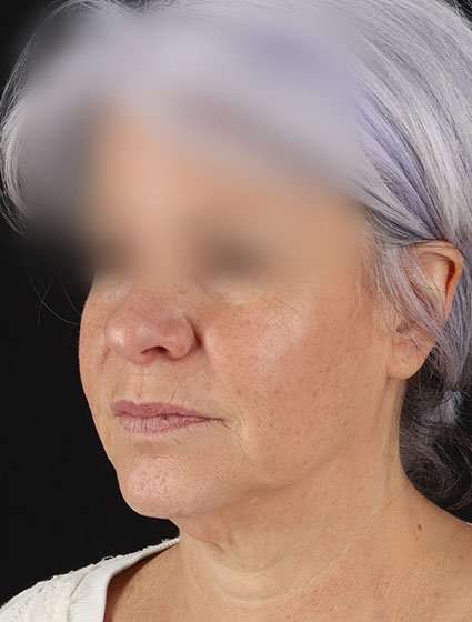 Neck Lift Before & After Patient #6878