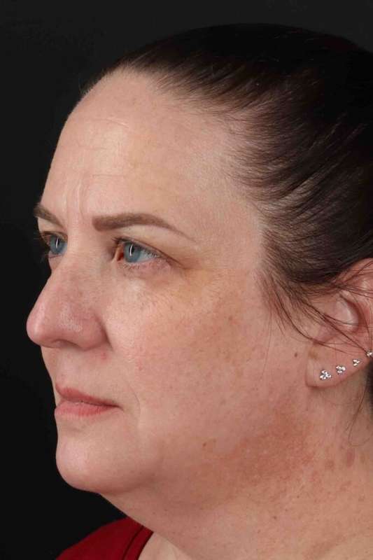 Neck Lift Before & After Patient #6898