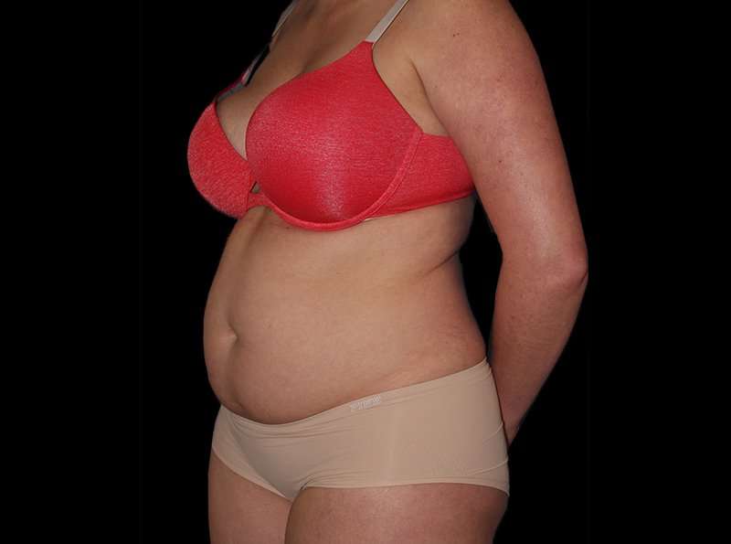 Liposuction Before & After Patient #1298