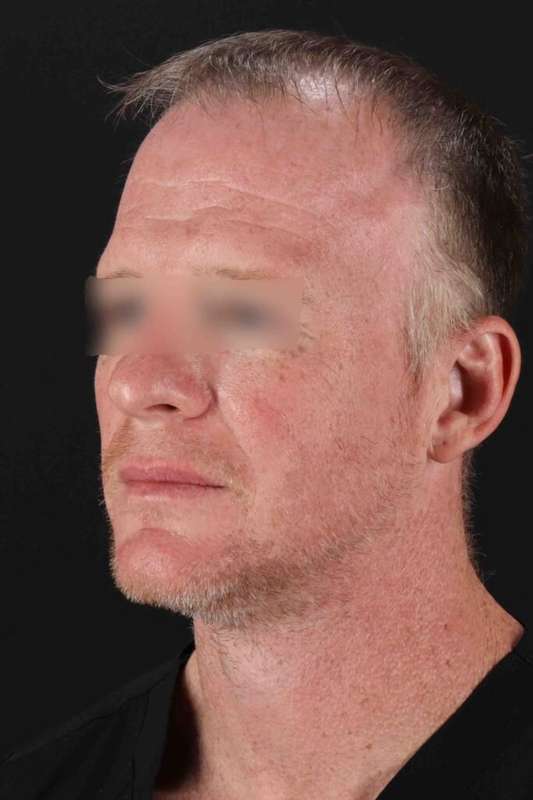 CO2 Laser Before & After Patient #6931