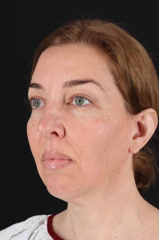 CO2 Laser Before & After Patient #6953