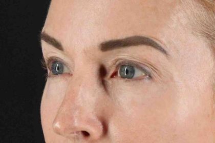 CO2 Laser Before & After Patient #7030