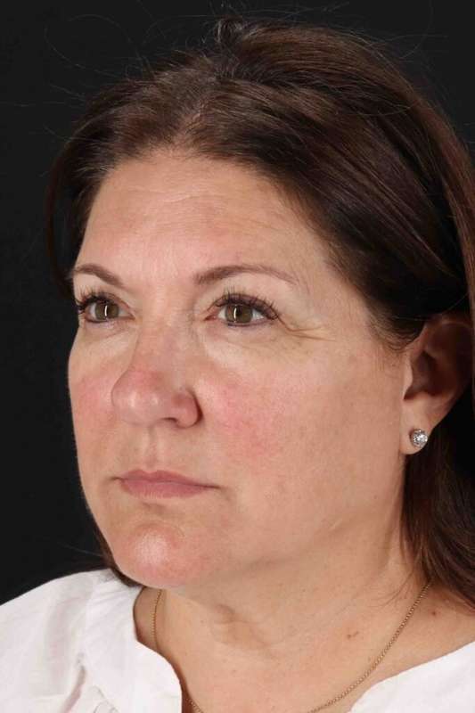 CO2 Laser Before & After Patient #7085