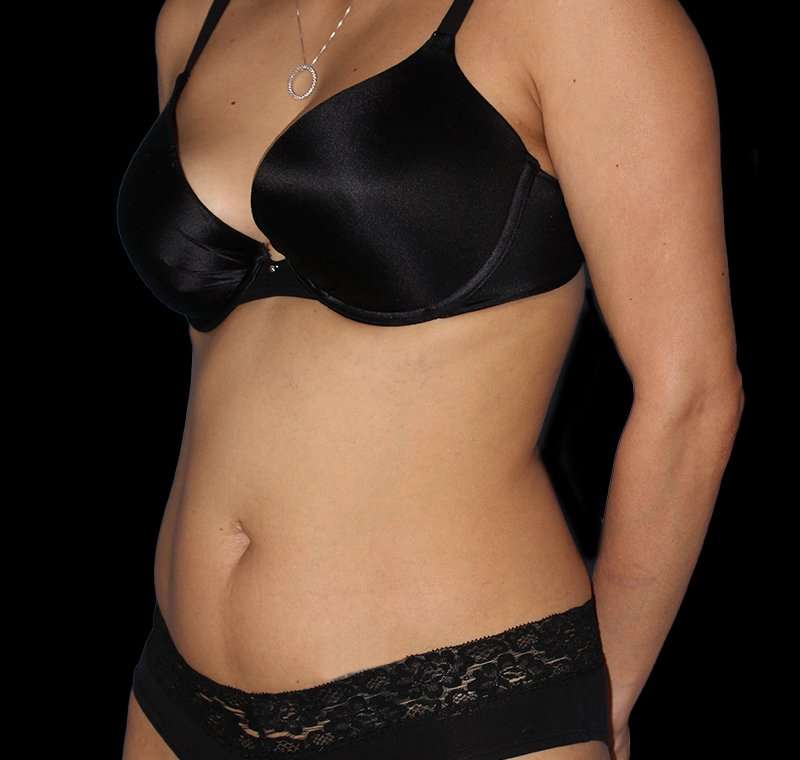 Liposuction Before & After Patient #1332