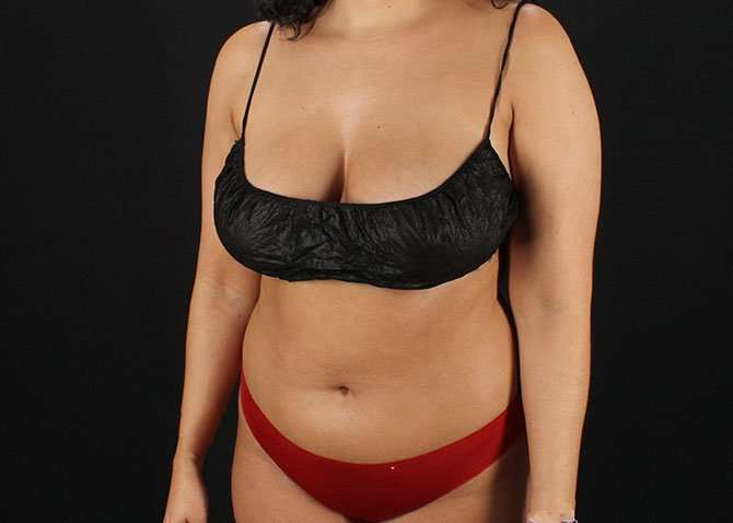 Liposuction Before & After Patient #1469